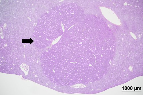 An image of a neoplastic lesion on a histology slide. A black arrow pointing at a lesion.
